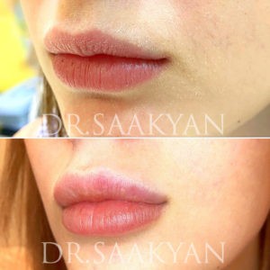 before-after